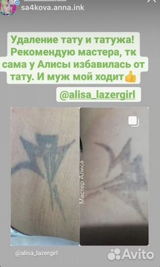 Лазерное удаление татуажа и тату