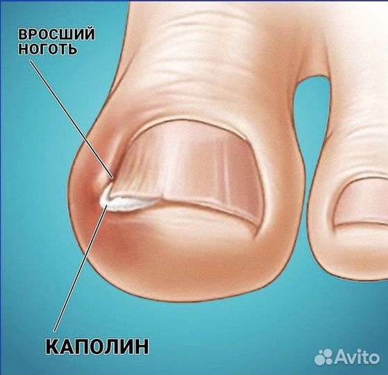 Вросший ноготь Подолог