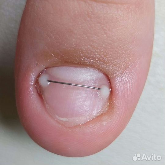 Титановая нить педикюр