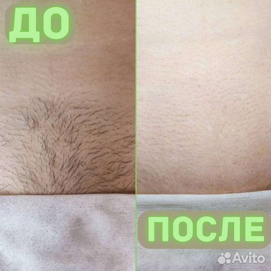 Шугаринг 1200 за 3 зоны