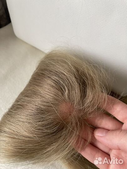 Система замещения волос