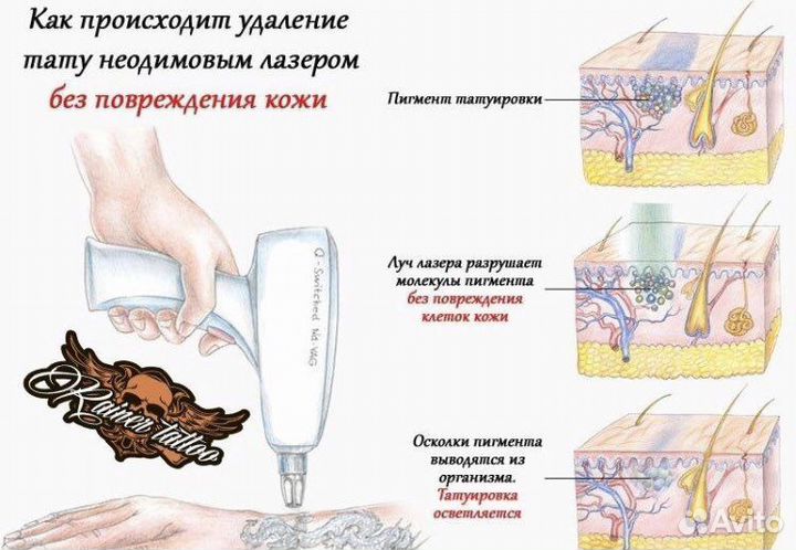 Удаление тату