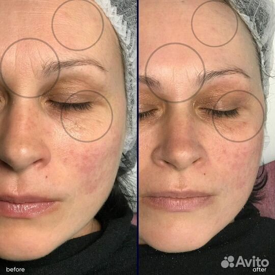 Фракционная мезотерапия