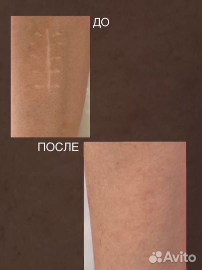 Удаление рубцов/шрамов/растяжек/витилиго /ареолы