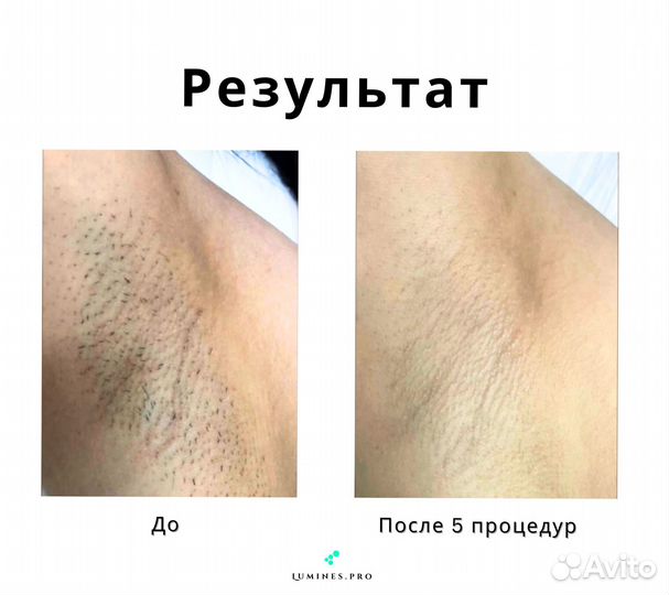 Диодный лазер для эпиляции Lumines. MaxOne 1200в