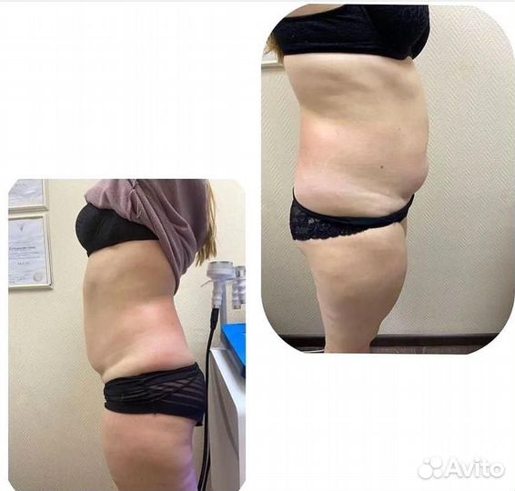 Аппаратный массаж комплексы для похудения