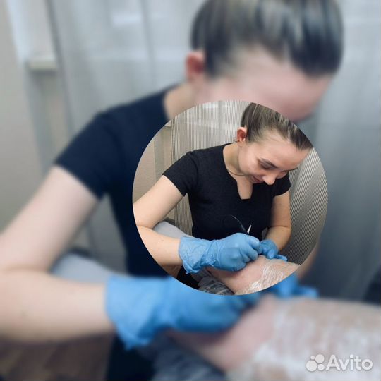 Электроэпиляция