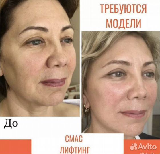 Модель на СМАС лифтинг