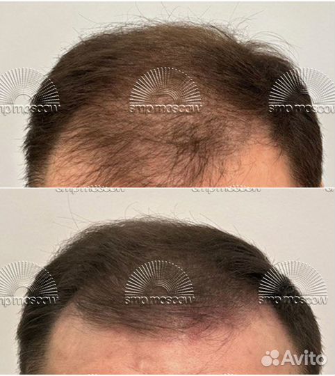 Имитация волос (фолликул), трихопигментация, smp