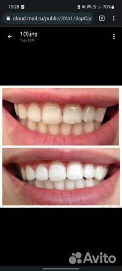 Отбеливание зубов