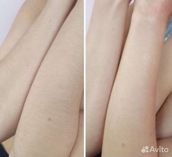Шугаринг на дому