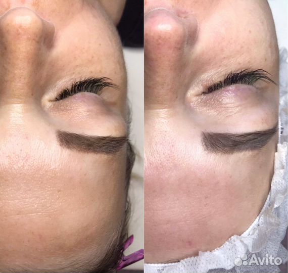 Чистка лица ищу модель