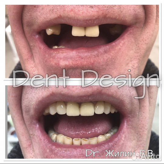 Гибкие протезы