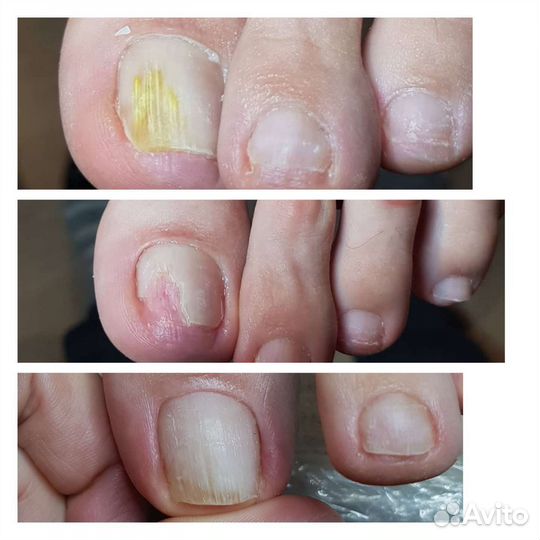 Подолог. Педикюр.лечебный педикюр. Сложные стопы