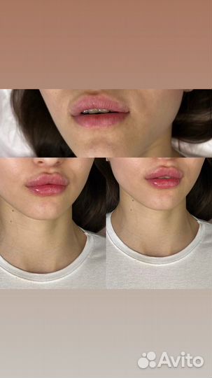 Требуются модели на всю контурную пластику