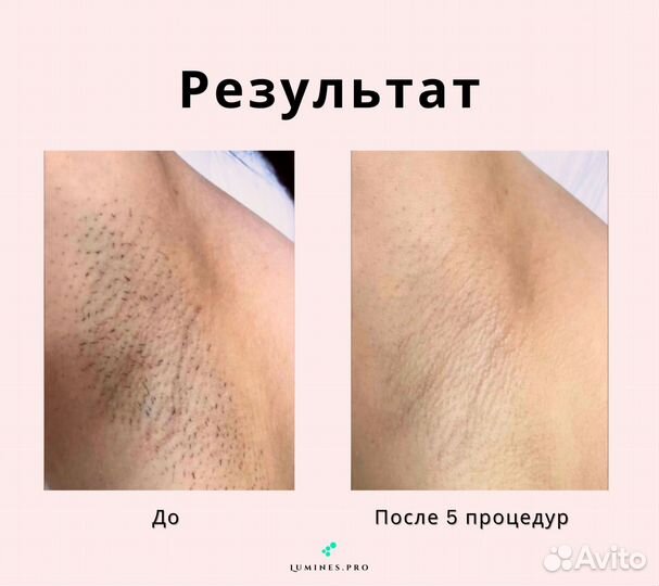 Аппарат для эпиляции люминес Max’One 1200