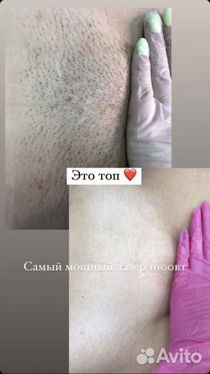 Лазерная эпиляция