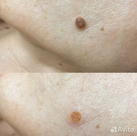 Удаление папиллом, родинок, бородавок