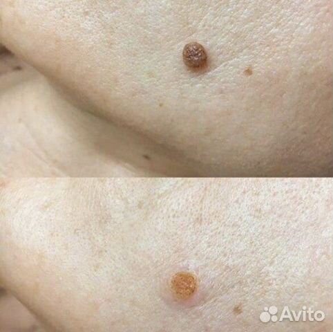 Удаление папиллом, родинок, бородавок