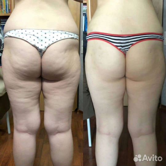 Антицеллюлитный массаж тела