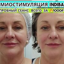 Миостимуляция indiba - активное омоложение кожи