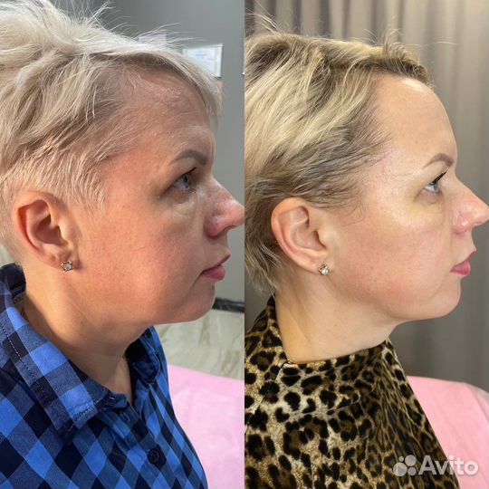 Rf лифтинг лица