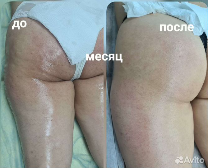 Похудение, коррекция фигуры