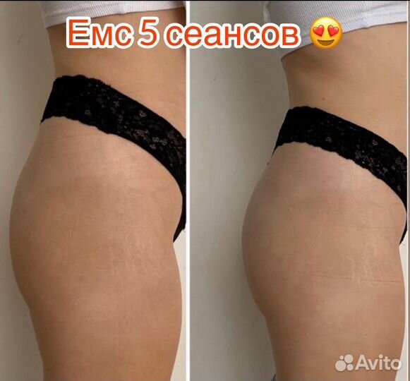 Lpg массаж,криолиполиз,емс,кавитация,rf лифтинг