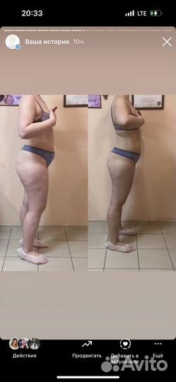 Эндо - Сфера, LPG массаж,вакуумный,корекция фигуры