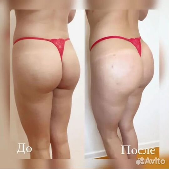 Увеличение ягодиц филлерами