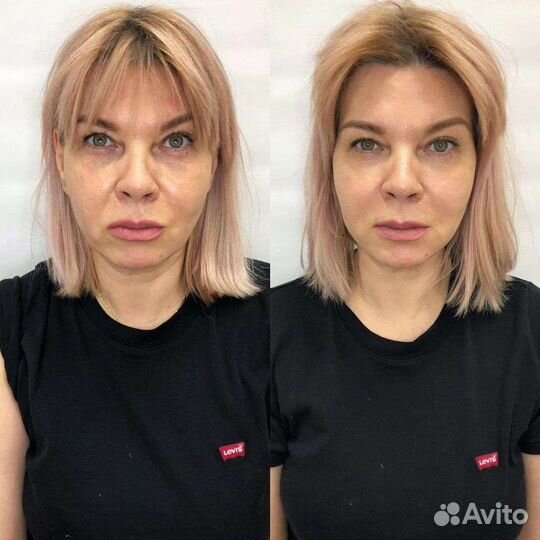 Консультация косметолога