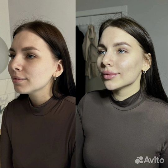 Требуются модели. Контурная пластика лица. Губы