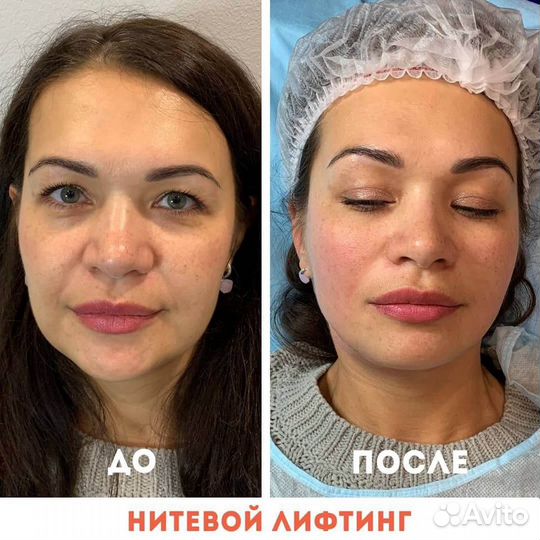 Нитевой лифтинг