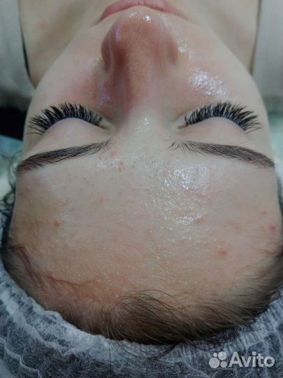 Чистка лица,пилинг,борьба с акне,постакне и др