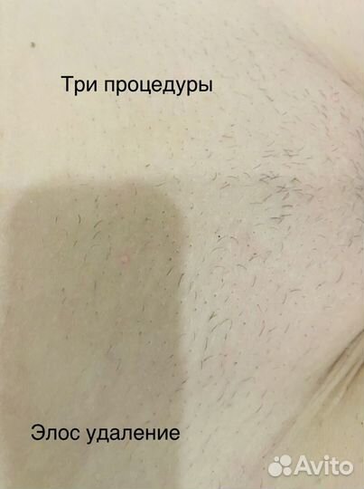 Лазерная Элос Эпиляция