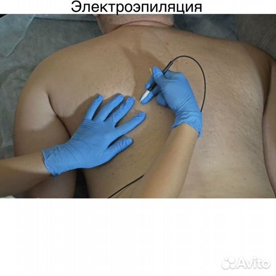 Электроэпиляция