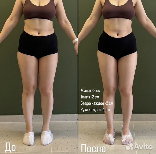 Аппаратный массаж Vela Shape. LPG нового поколения