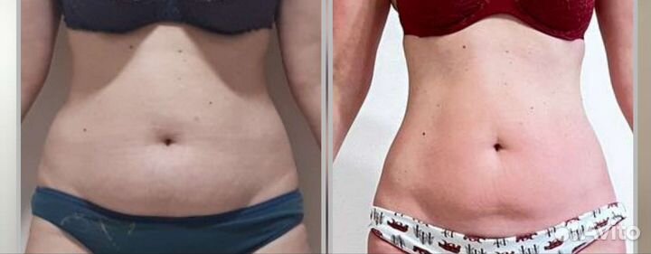 Криолиполиз