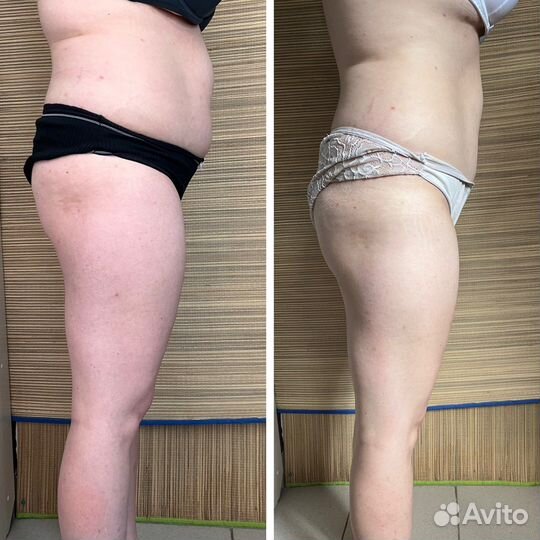 Массаж триггерных точек