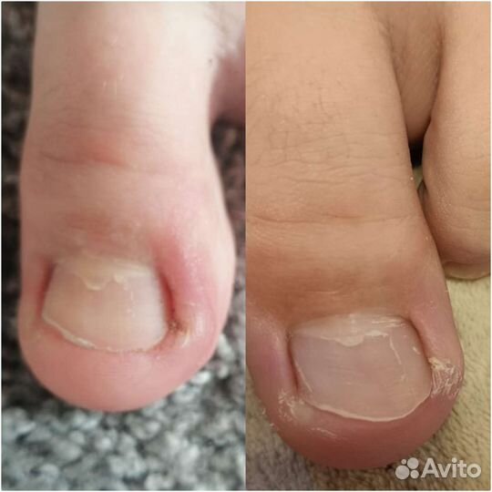 Педикюр подолог