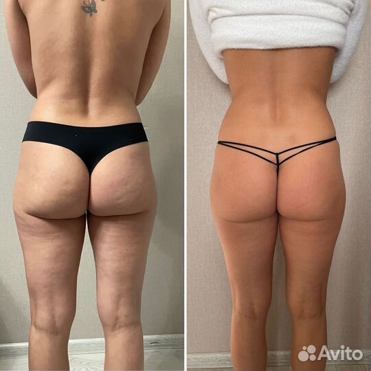 LPG массаж B-flexy