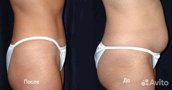 Армопластика