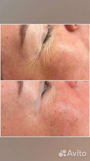 УЗ чистка,Кавитация, вакуумный массаж, рф-лифтинг