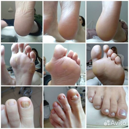 Педикюр подология