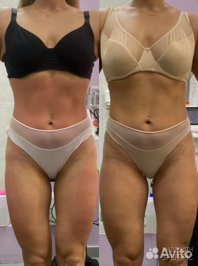 Коррекции фигуры (аппаратная и много др)