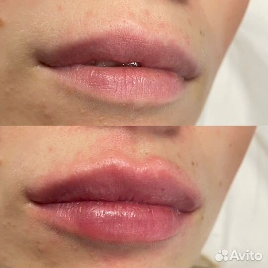 Косметолог, ботокс для лица, увеличение губ