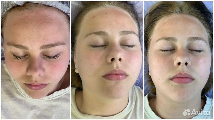 Косметолог. Чистка лица, лечение акне, омоложение