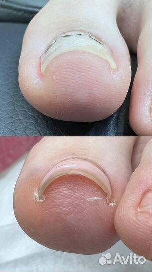 Подолог / Лечебный педикюр