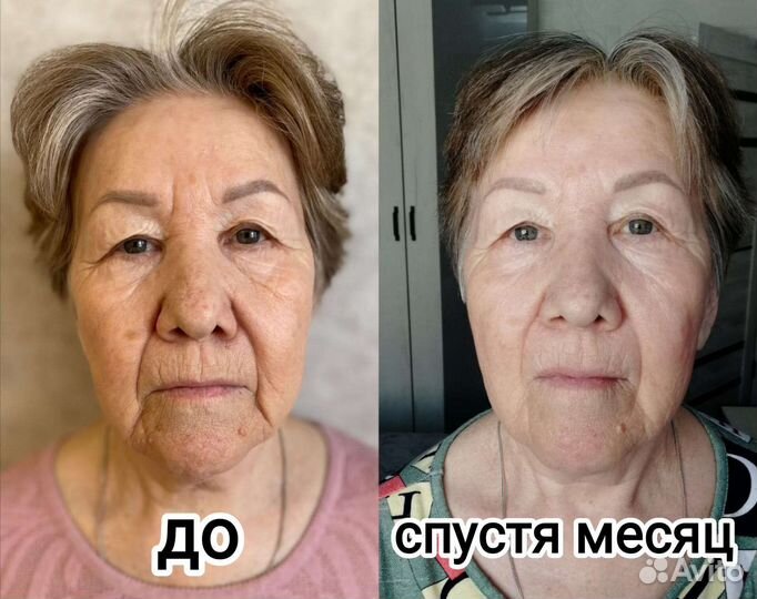 Кавитация, смас-лифтинг, RF- лифтинг, биофотон