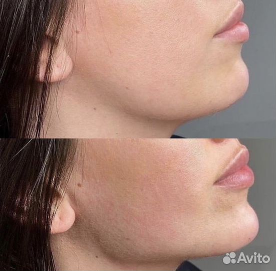 Биоревитализация